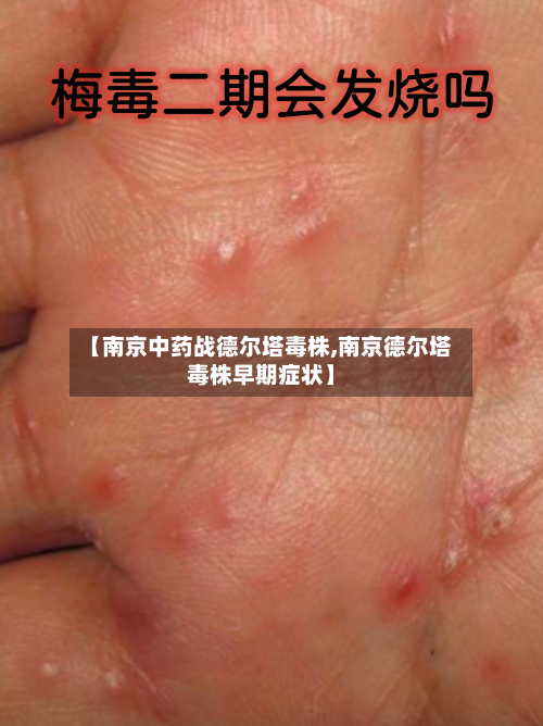 【南京中药战德尔塔毒株,南京德尔塔毒株早期症状】