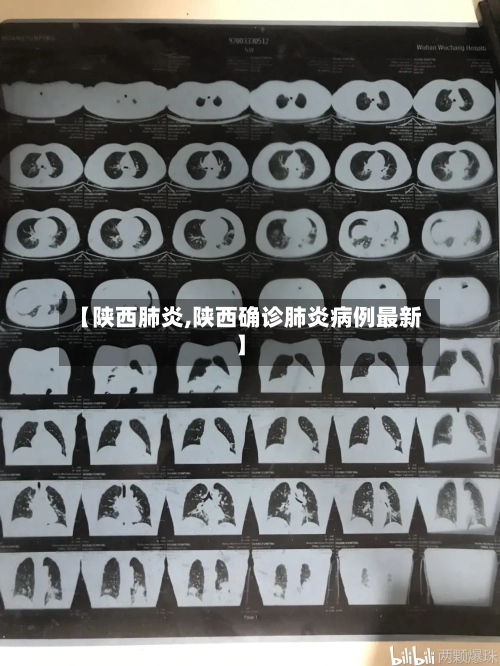 【陕西肺炎,陕西确诊肺炎病例最新】