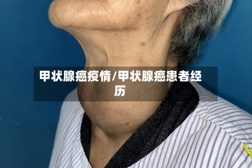 甲状腺癌疫情/甲状腺癌患者经历-第3张图片