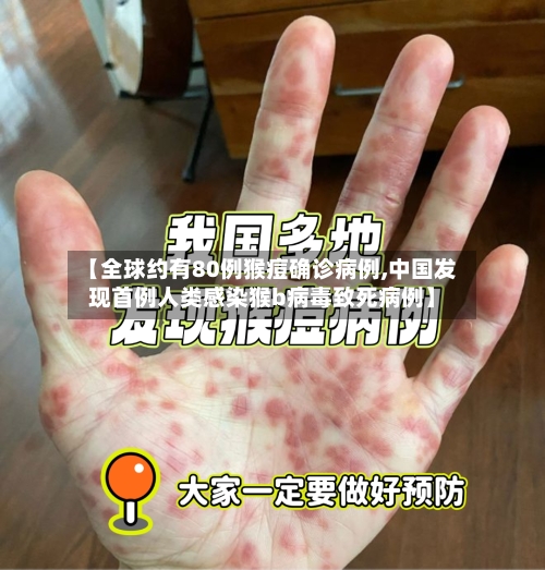 【全球约有80例猴痘确诊病例,中国发现首例人类感染猴b病毒致死病例】