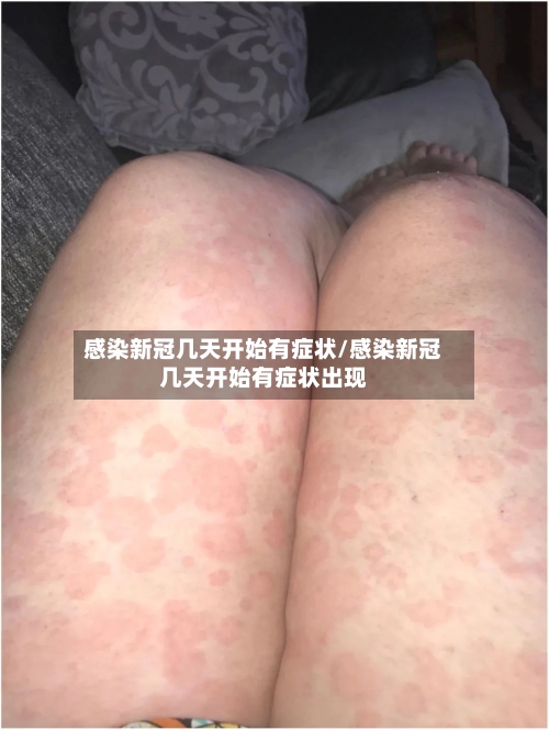 感染新冠几天开始有症状/感染新冠几天开始有症状出现