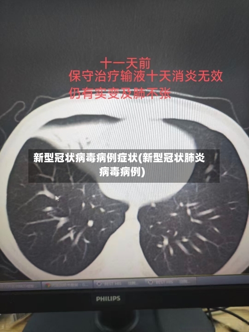 新型冠状病毒病例症状(新型冠状肺炎病毒病例)-第3张图片